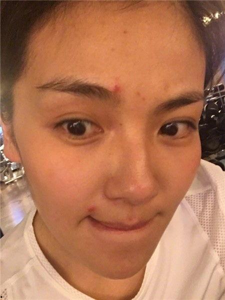 长痘痘的明星图片,揭秘长痘瞬间，美丽背后的战“痘”故事